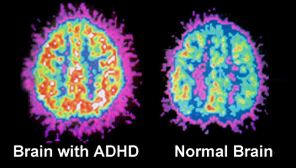 adhd